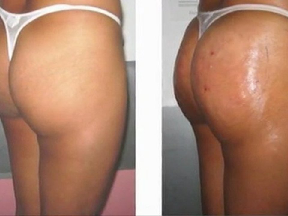 cirugia gluteos