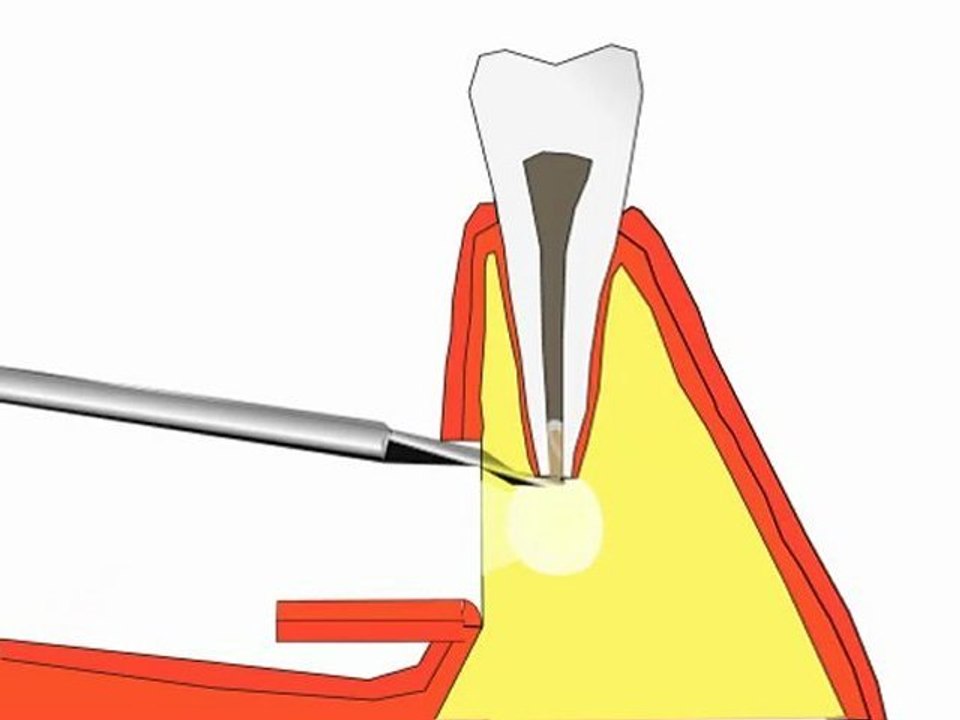 Résection apicale