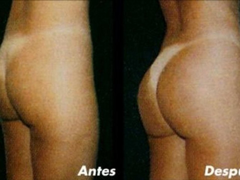 implantes de gluteos precios