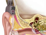 Hearing Aids, Cochlear Implants and Assistive Listening Devices