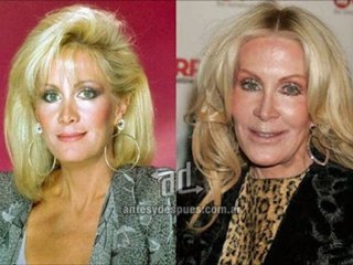 cirugias de nariz precios