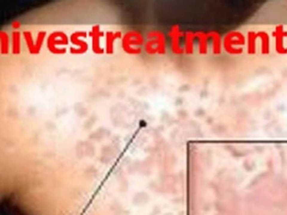 oxyhives treatment