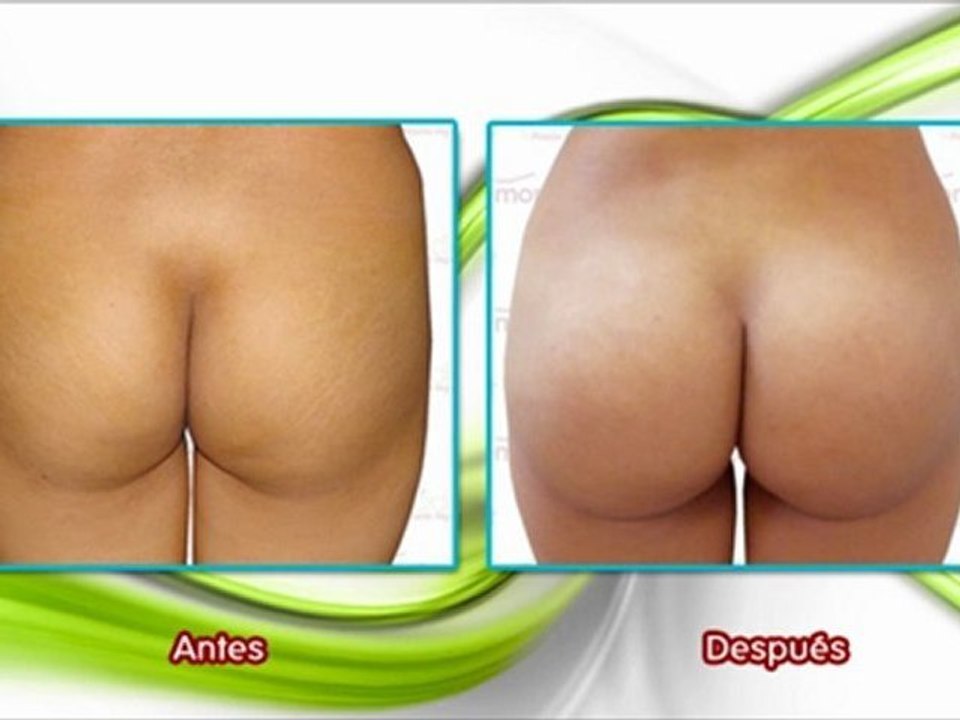 operación de glúteos