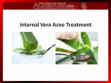 Permanently Cure Your Acne Breakouts Using the Aloe Vera Acne Treatment