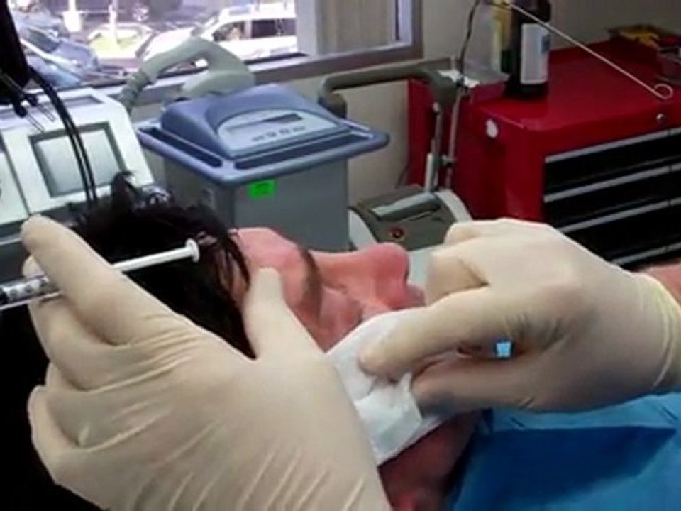 Vampire Facelift Before and After, Watch Vampire ...