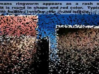 Ringworm Information