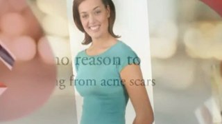 Fade Acne Scars Treatments - Good News