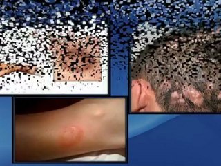 Complete Ringworm Cure Guide