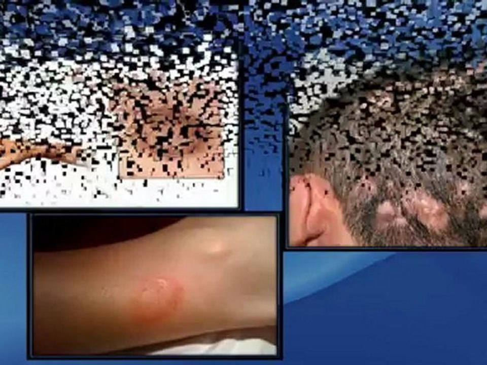 Complete Ringworm Cure Guide