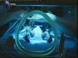 Bebes prematuros: Ventilacion liquida (El utero artificial)