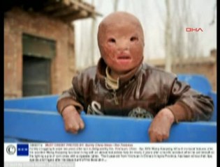 Yüzü Olmayan Çocuk Nakil Bekliyor