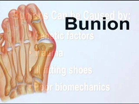 Bunion Surgery Patient – Podiatrist - Valley Stream, Lake Success, NY