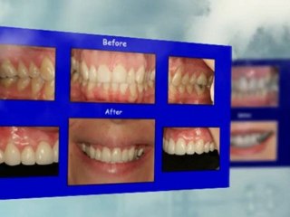 Dental Implants Long Island