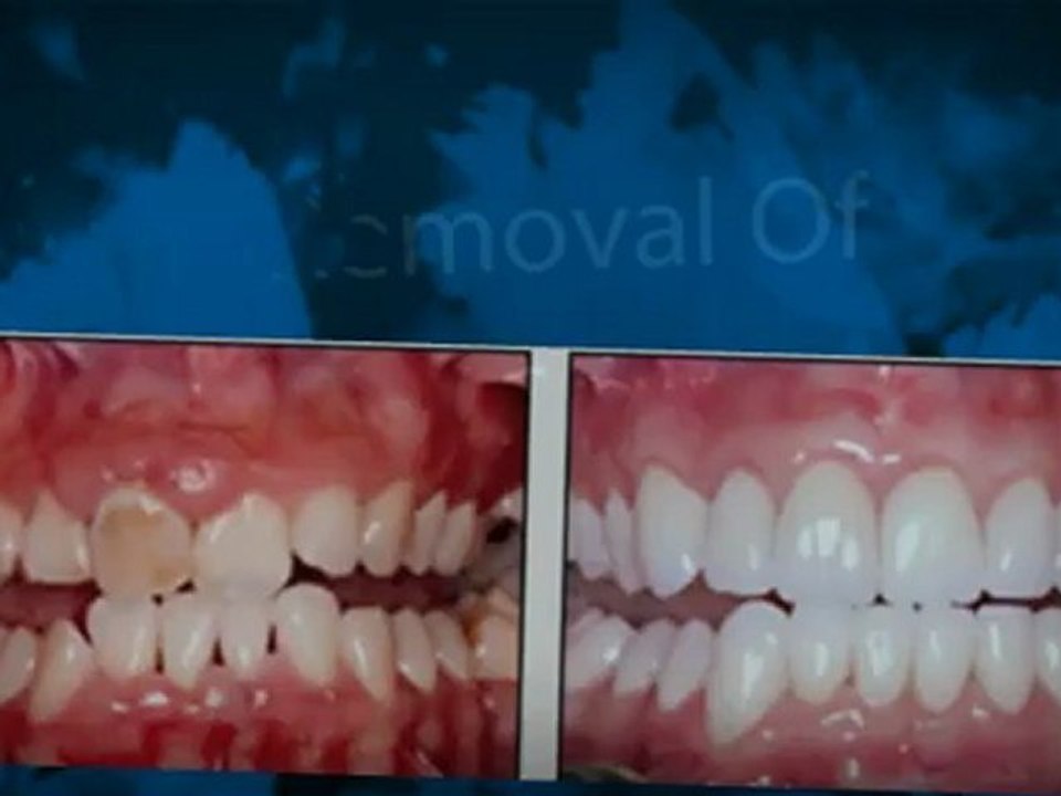 Dental Implants Detroit