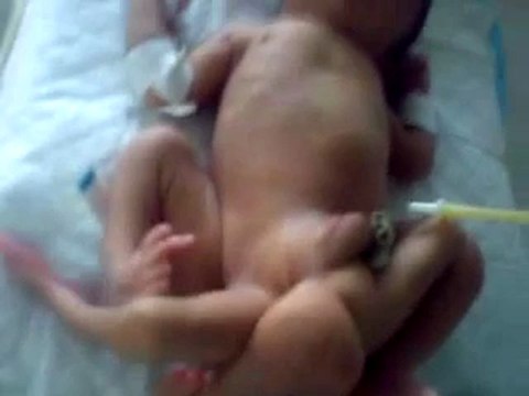 Bébé 6 jambes au Pakistan