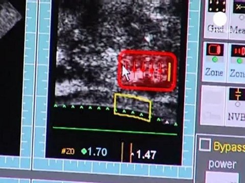 New prostate cancer treatment reduces side effects