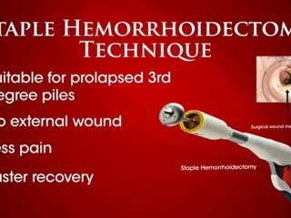 Piles Surgery Singapore, Colorectal surgeon – NY Wong Surgery