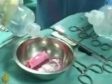 Stem cells used in organ surgery - 20 November 2008
