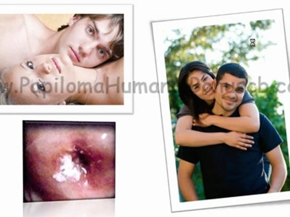 TRATAMIENTO PAPILOMA HUMANO EN HOMBRES