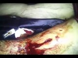 فري برس دمشق مصاب طعن بسكين شبيح اسدي مجرم  في الميدان 20 4 2012 Damascus