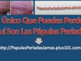 Tratamiento Papulas Perladas Del Pene