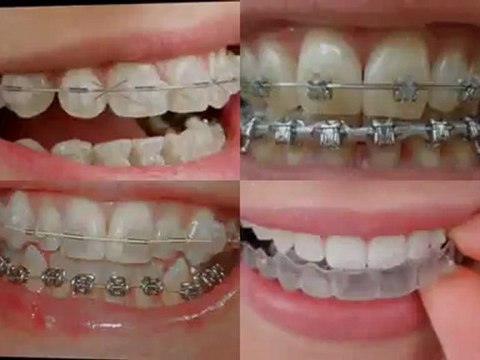 Great Lakes IL Orthodontic Treatment with Braces for Children on Public Aid, Medicaid and All Kids near Great Lakes Illinois.