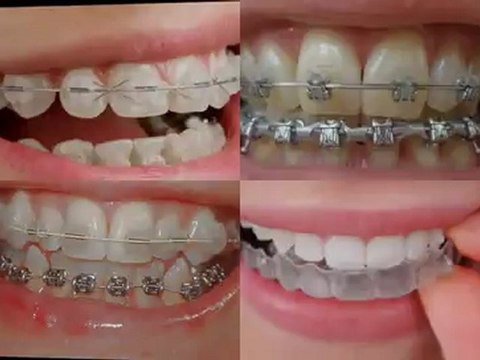 Lindenhurst IL Orthodontic Treatment with Braces for Children on Public Aid, Medicaid and All Kids near Lindenhurst Illinois.