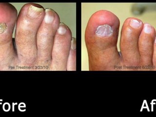 Laser Treatment  for Toenail Fungus
