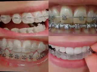 Winthrop Harbor IL Orthodontic Braces for Children on Public Aid, Medicaid and All Kids near Winthrop Harbor Illinois.