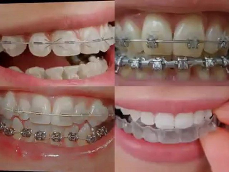 Winthrop Harbor IL Orthodontic Braces for Children on Public Aid, Medicaid and All Kids near Winthrop Harbor Illinois.