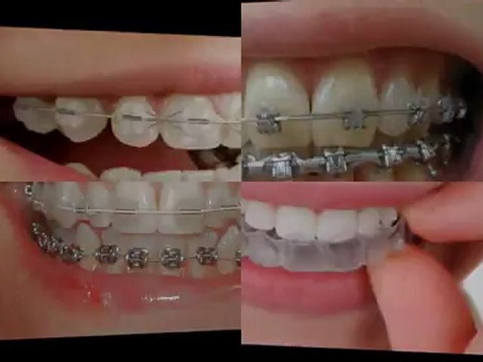 Zion IL Orthodontic Braces for Children on Public Aid, Medicaid and All Kids near Zion Illinois.