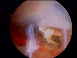 Orthoglide Knee resurfacing