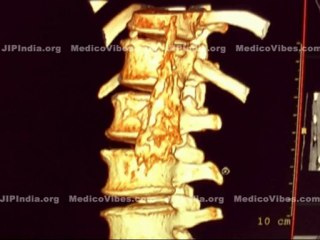 CT Coeliac (Lateral approach) Plexus Block