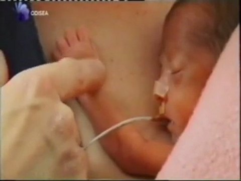 Bebes prematuros: Metodo Canguro