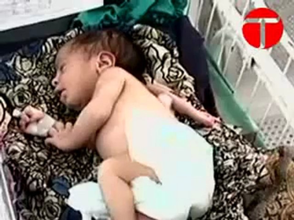 Three-armed baby