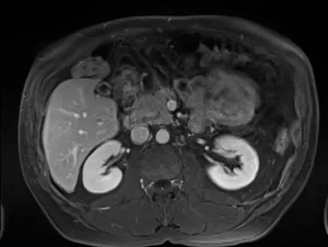 Ciné _Argus FOIE - radiologie lyon nord