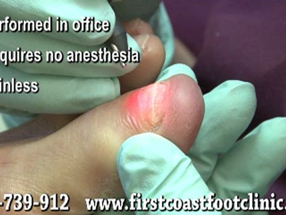 Laser Treatment for Fungal Toenails - Podiatrist in Jacksonville, FL