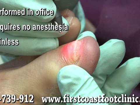 Laser Treatment for Fungal Toenails - Podiatrist in Jacksonville, FL