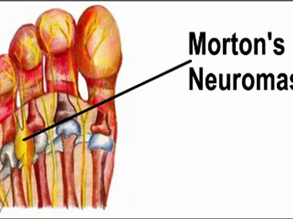 Neuromas - Podiatrist in Frederick, Germantown and Hagerstown, MD