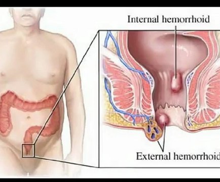 Hemorrhoids Piles, Curing Hemorrhoids & Hemorrhoids Relief