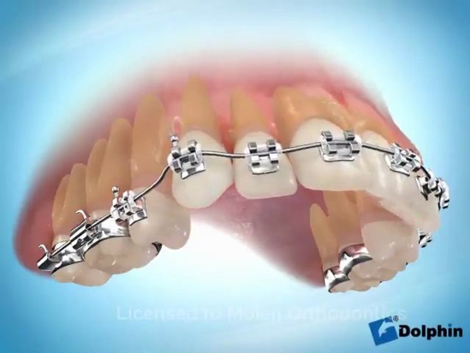 orthodontie : alignement des dents supérieure (12 13)