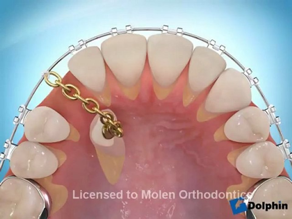 canine incluse et orthodontie