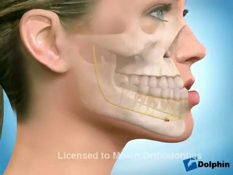 Chirurgie pour Progénie ou Prognathie mandibulaire - Vidéo Dailymotion