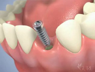 couronne sur implants
