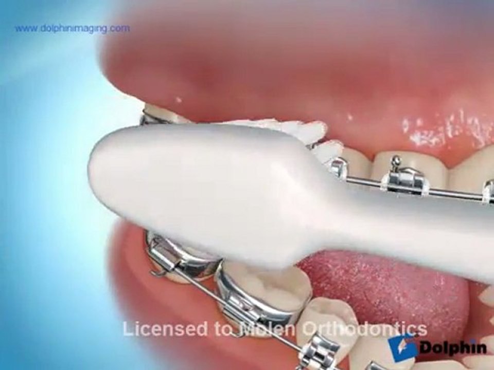 Hygiène en orthodontie