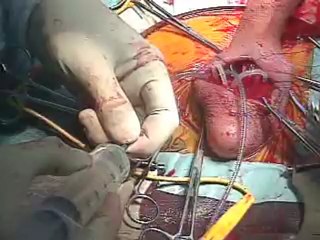 COLOPLAST 3 PARÇA PENİS PROTEZ Alpha I Scrotal Approch