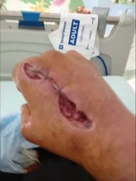 Une main attaque par une raie