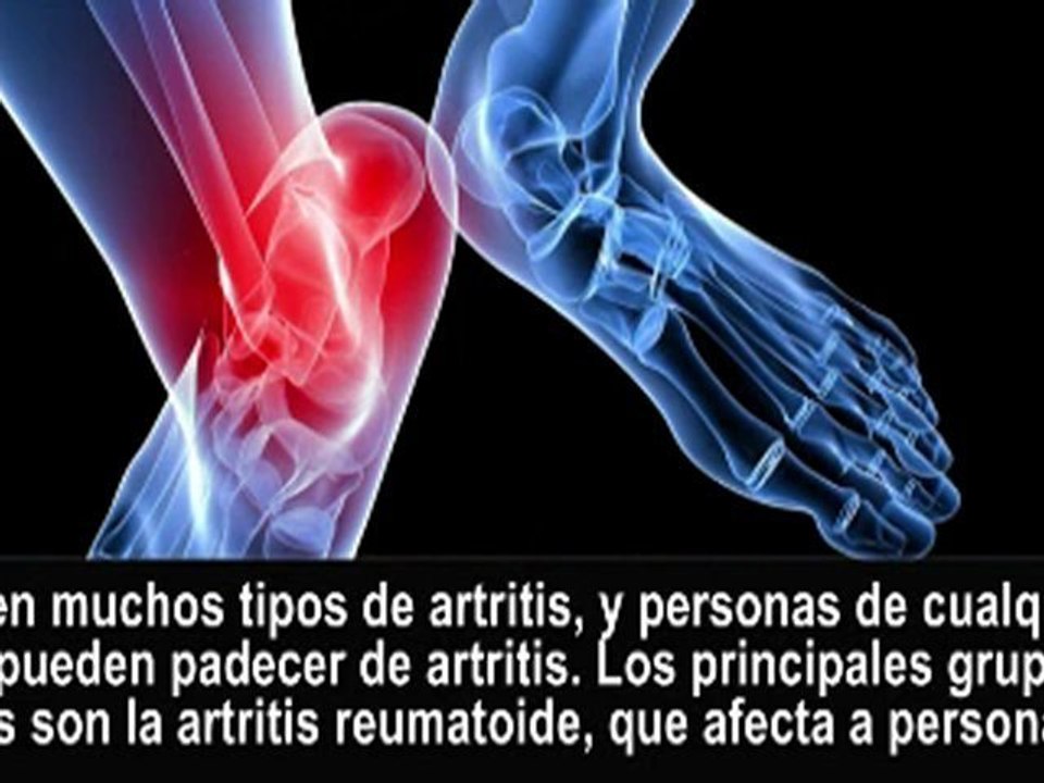 Cuidado del Pie Artrítico - Podólogo en NYC Manhattan y White Plains, NY