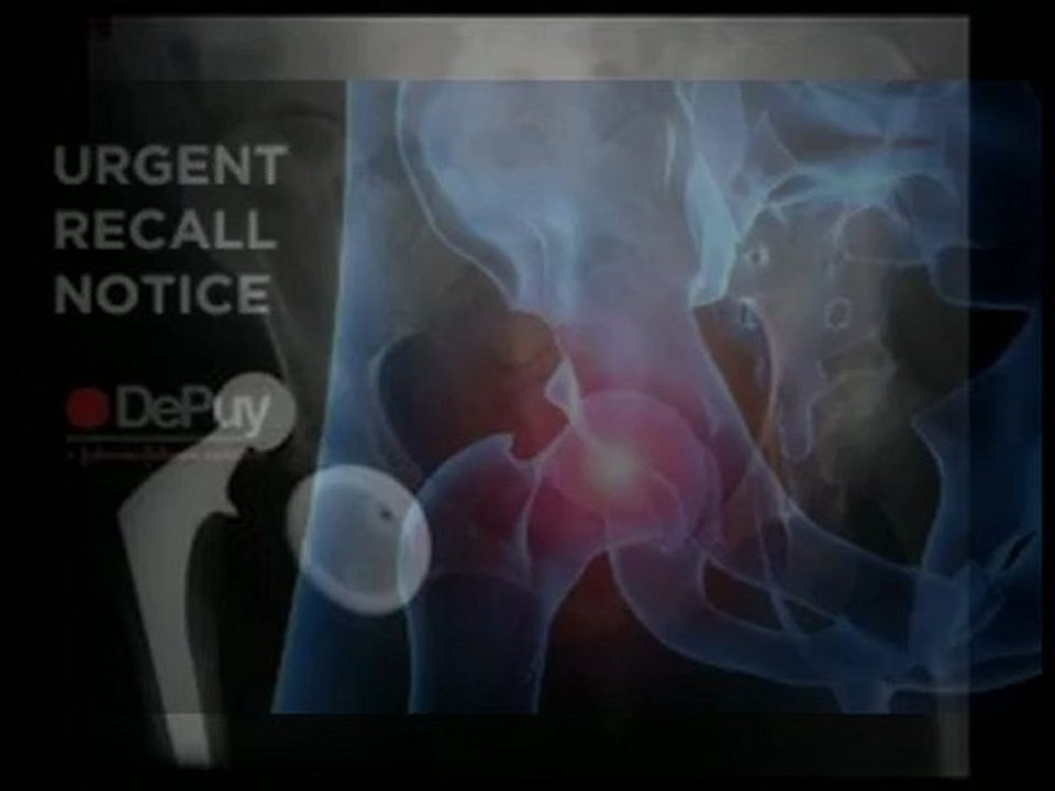 Seek Help from a Depuy Hip Recall Lawyer