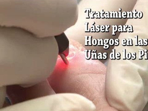 Láser para Hongos en las Uñas de los Pies - Podólogo en NYC Manhattan y White Plains, NY